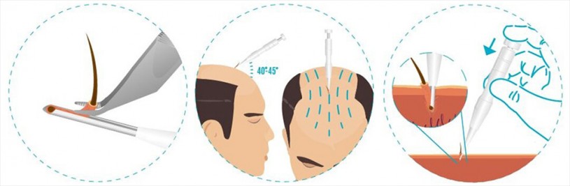 
                                direct hair transplant