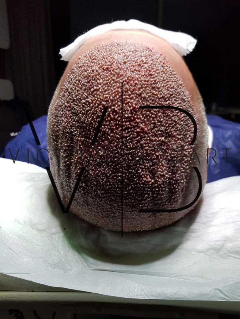 
                                hair transplant